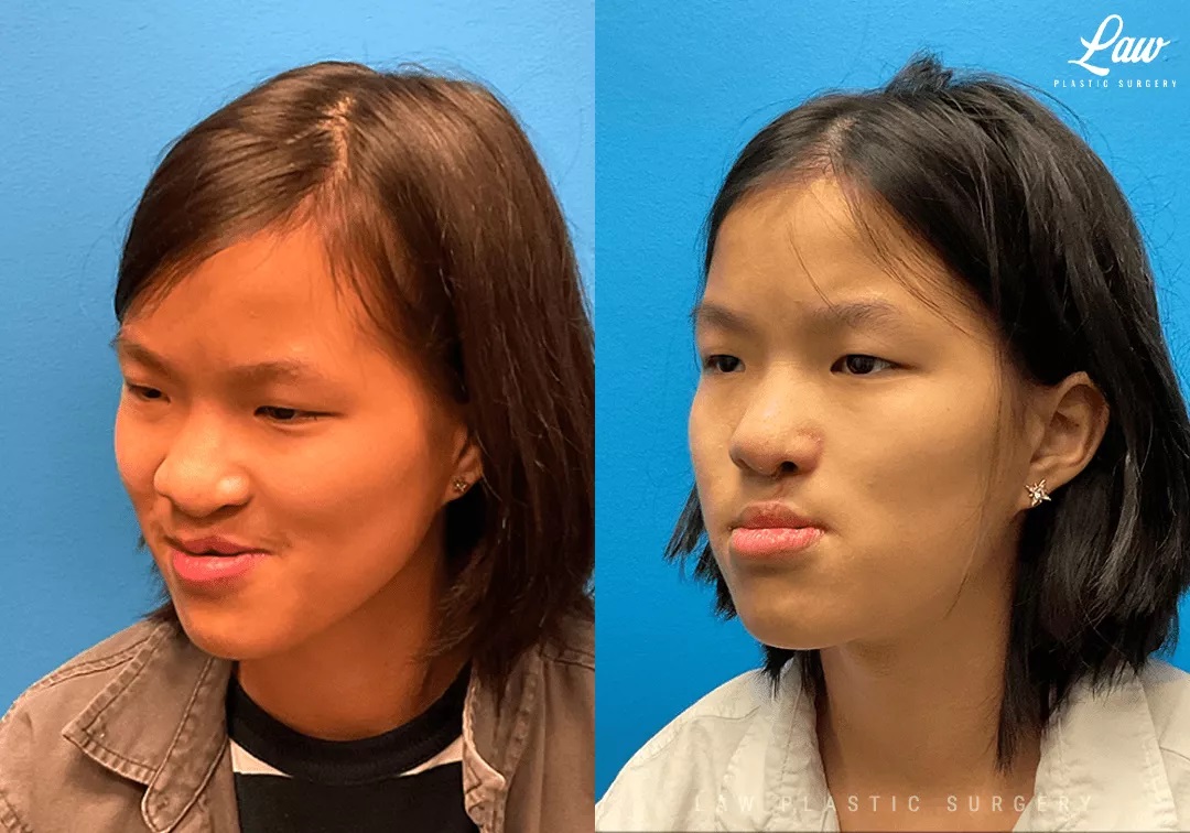 Cleft Rhinoplasty (Cleft Nose Surgery) Before & After Photo. Surgery performed in Dallas, TX at Law Plastic Surgery.