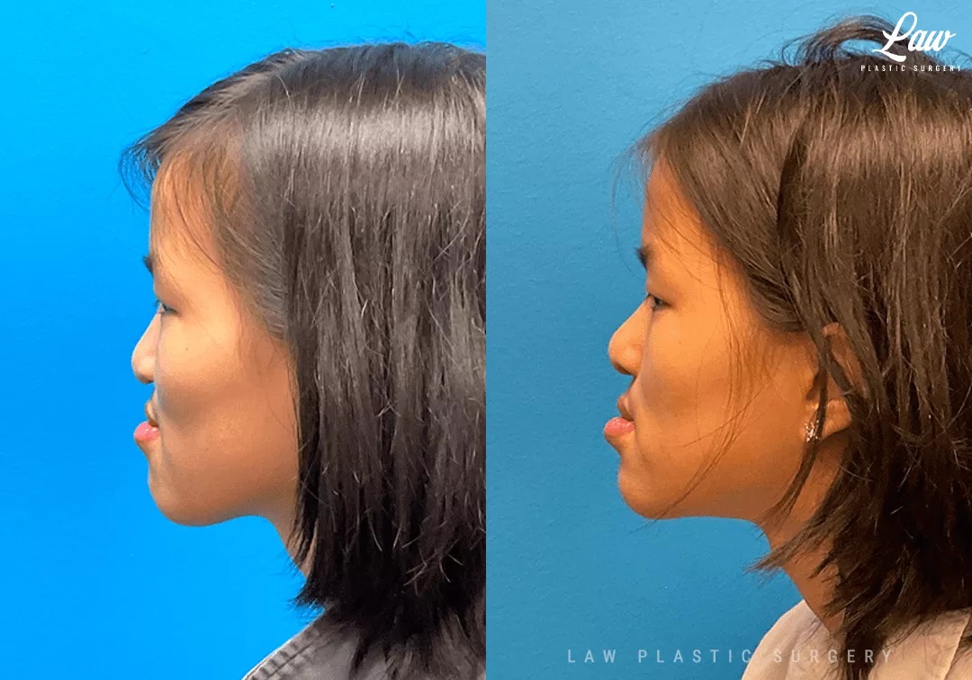 Cleft Rhinoplasty (Cleft Nose Surgery) Before & After Photo. Surgery performed in Dallas, TX at Law Plastic Surgery.