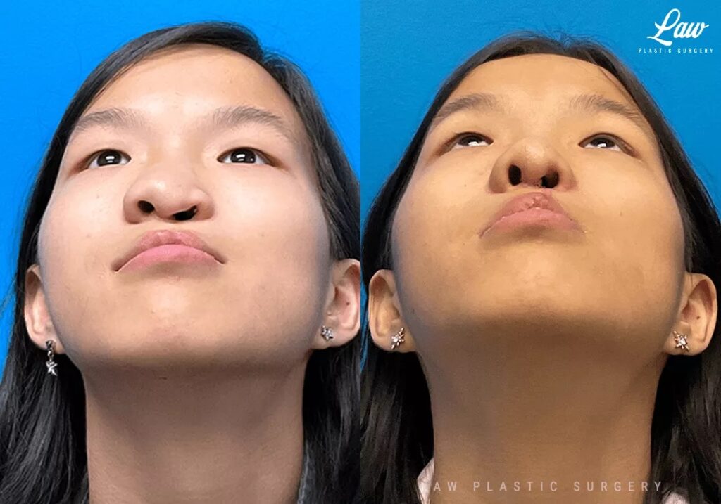 Cleft Rhinoplasty Before & After Photos - Law Plastic Surgery
