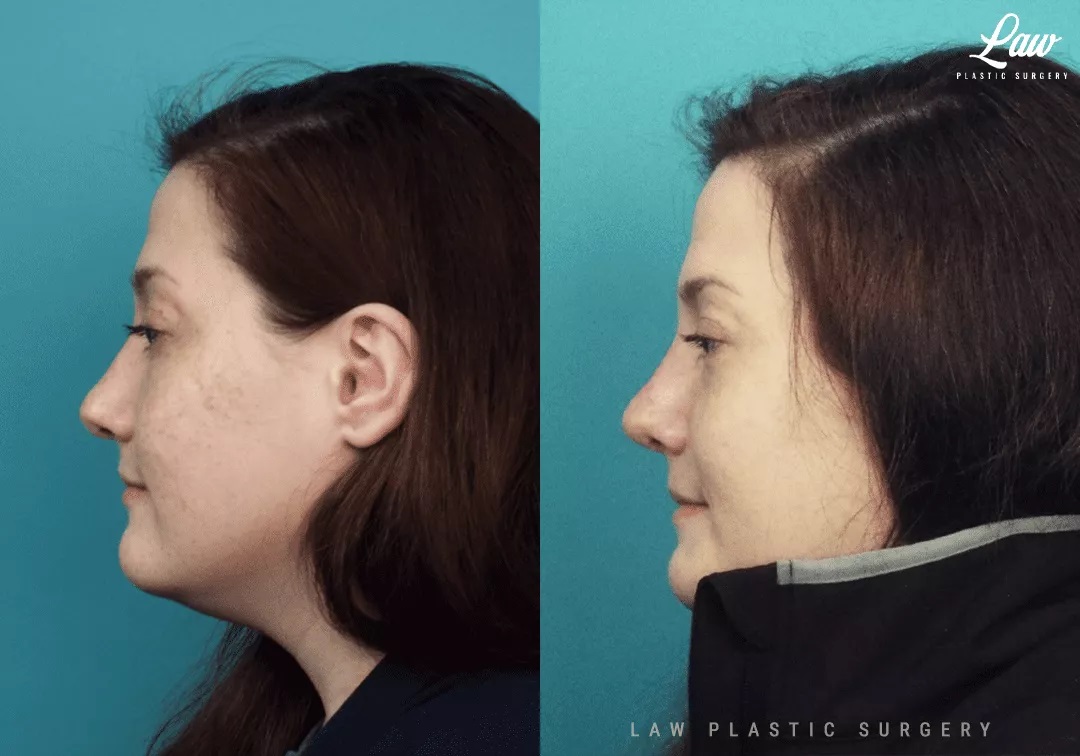 Cleft Rhinoplasty (Cleft Nose Surgery) Before & After Photo. Surgery performed in Dallas, TX at Law Plastic Surgery.