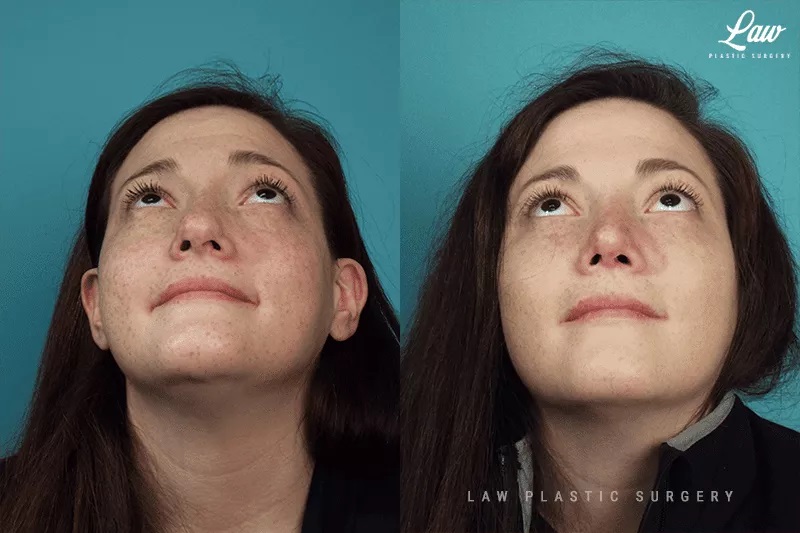 Cleft Rhinoplasty (Cleft Nose Surgery) Before & After Photo. Surgery performed in Dallas, TX at Law Plastic Surgery.