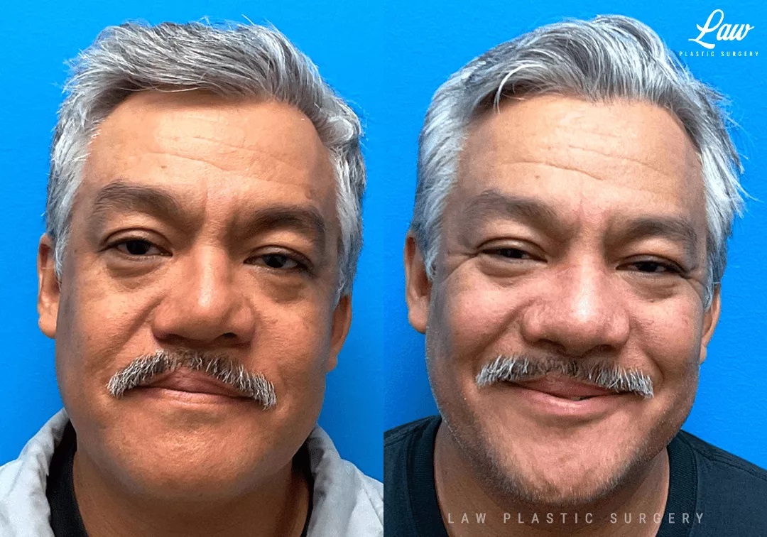 Cleft Rhinoplasty (Cleft Nose Surgery) Before & After Photo. Surgery performed in Dallas, TX at Law Plastic Surgery.