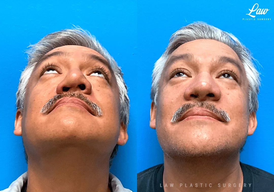 Cleft Rhinoplasty (Cleft Nose Surgery) Before & After Photo. Surgery performed in Dallas, TX at Law Plastic Surgery.