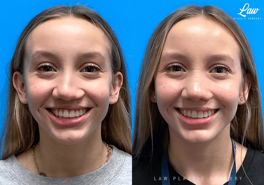Cleft Rhinoplasty (Cleft Nose Surgery) Before & After Photo. Surgery performed in Dallas, TX at Law Plastic Surgery.