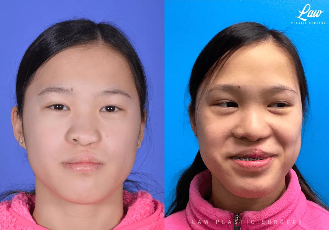 Cleft Rhinoplasty (Cleft Nose Surgery) Before & After Photo. Surgery performed in Dallas, TX at Law Plastic Surgery.