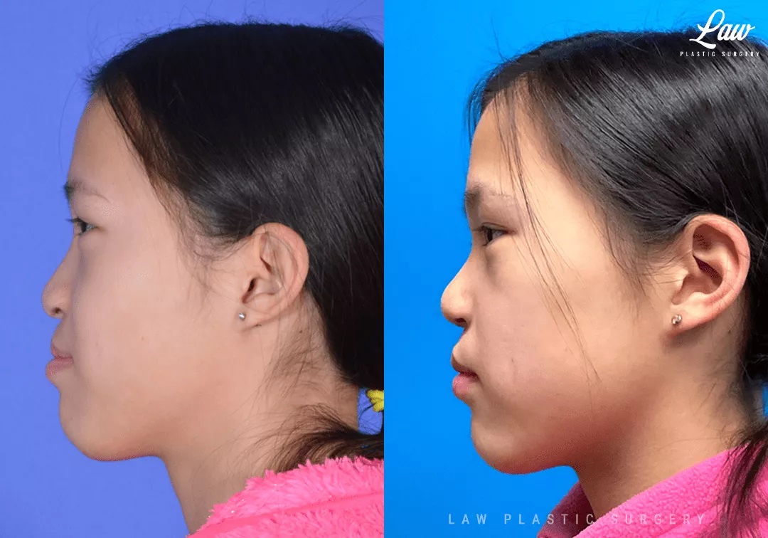 Cleft Rhinoplasty (Cleft Nose Surgery) Before & After Photo. Surgery performed in Dallas, TX at Law Plastic Surgery.