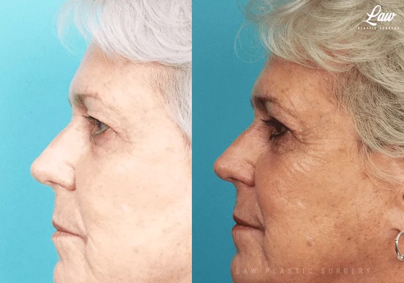 Eyelid Surgery (Blepharoplasty) Before & After Photo. Surgery performed in Dallas, TX at Law Plastic Surgery.