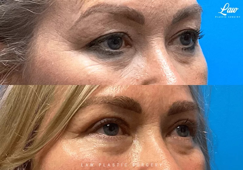 Eyelid Surgery (Blepharoplasty) Before & After Photo. Surgery performed in Dallas, TX at Law Plastic Surgery.