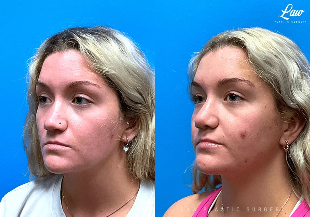 Rhinoplasty (Nose Job) Before & After Photo. Surgery performed in Dallas, TX at Law Plastic Surgery.