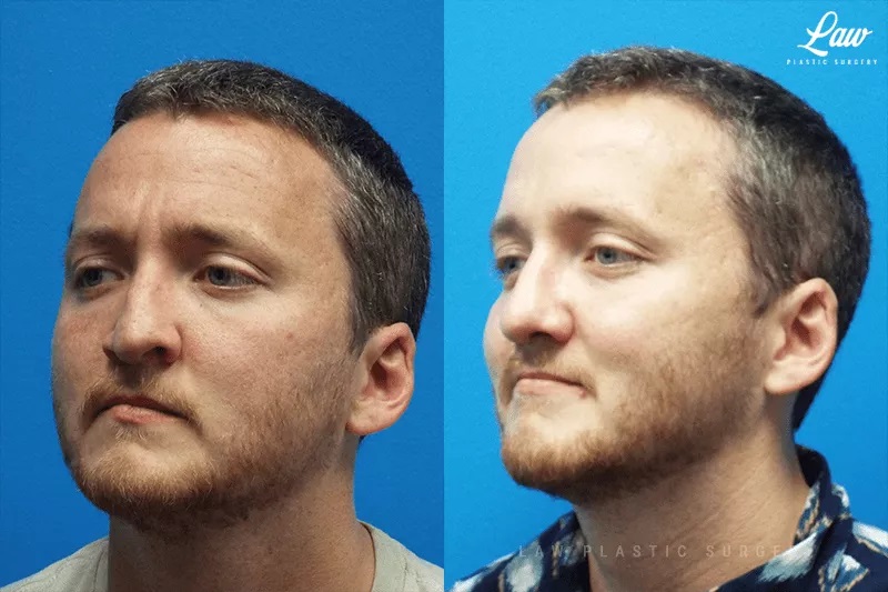 Rhinoplasty (Nose Job) Before & After Photo. Surgery performed in Dallas, TX at Law Plastic Surgery.