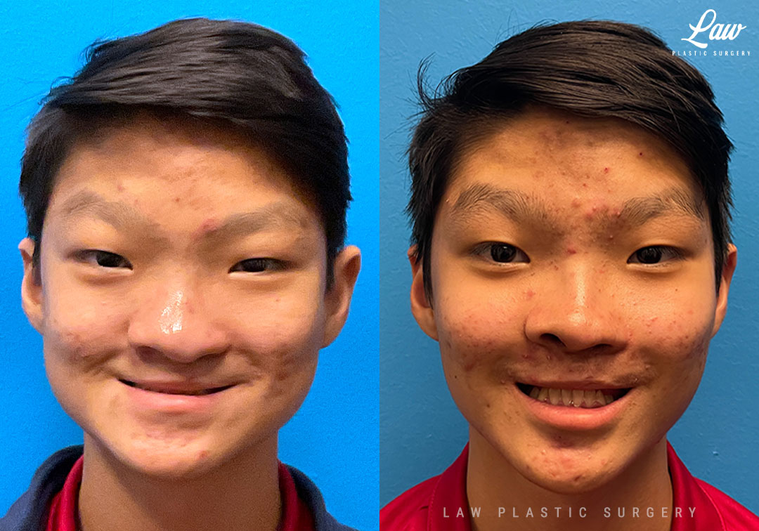 Cleft Rhinoplasty (Cleft Nose Surgery) Before & After Photo. Surgery performed in Dallas, TX at Law Plastic Surgery.