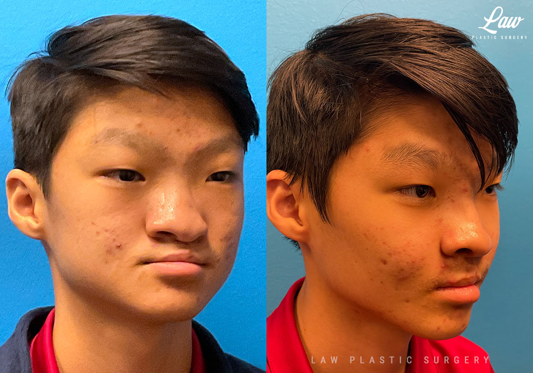 Cleft Rhinoplasty (Cleft Nose Surgery) Before & After Photo. Surgery performed in Dallas, TX at Law Plastic Surgery.