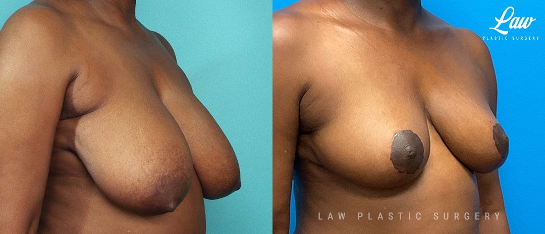 Breast Reduction Before and After Photo. Surgery performed in Dallas, TX at Law Plastic Surgery.