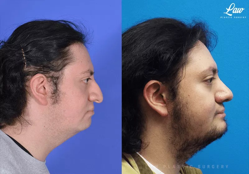 Chin Surgery (Genioplasty) Before and After Photo. Surgery performed in Dallas, TX at Law Plastic Surgery.