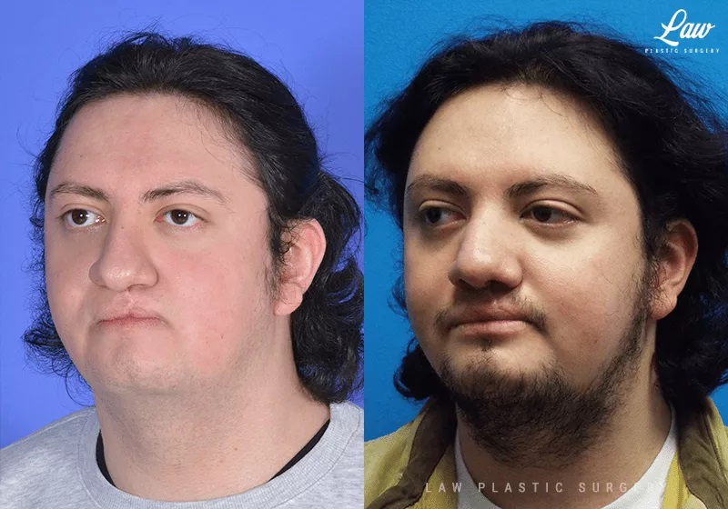 Chin Surgery (Genioplasty) Before and After Photo. Surgery performed in Dallas, TX at Law Plastic Surgery.