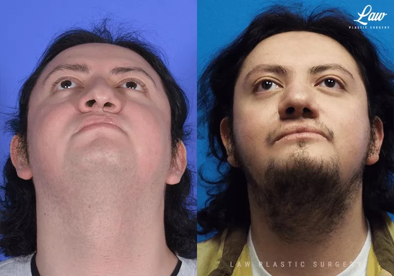 Cleft Chin Before And After