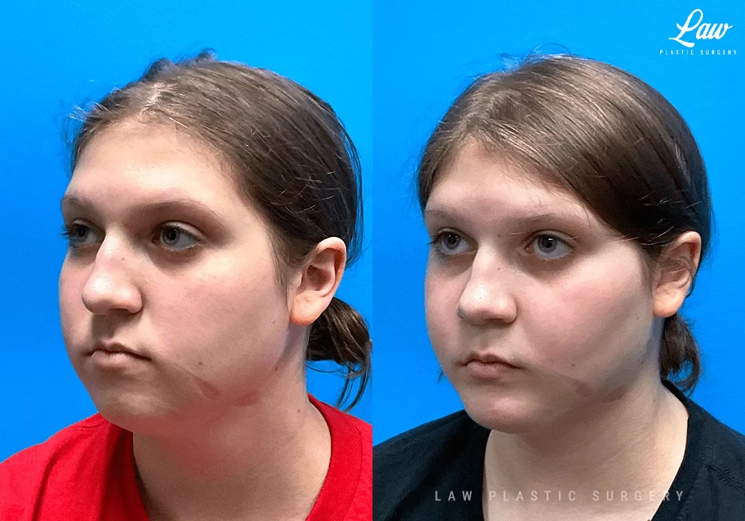 Chin Surgery (Genioplasty) Before and After Photo. Surgery performed in Dallas, TX at Law Plastic Surgery.