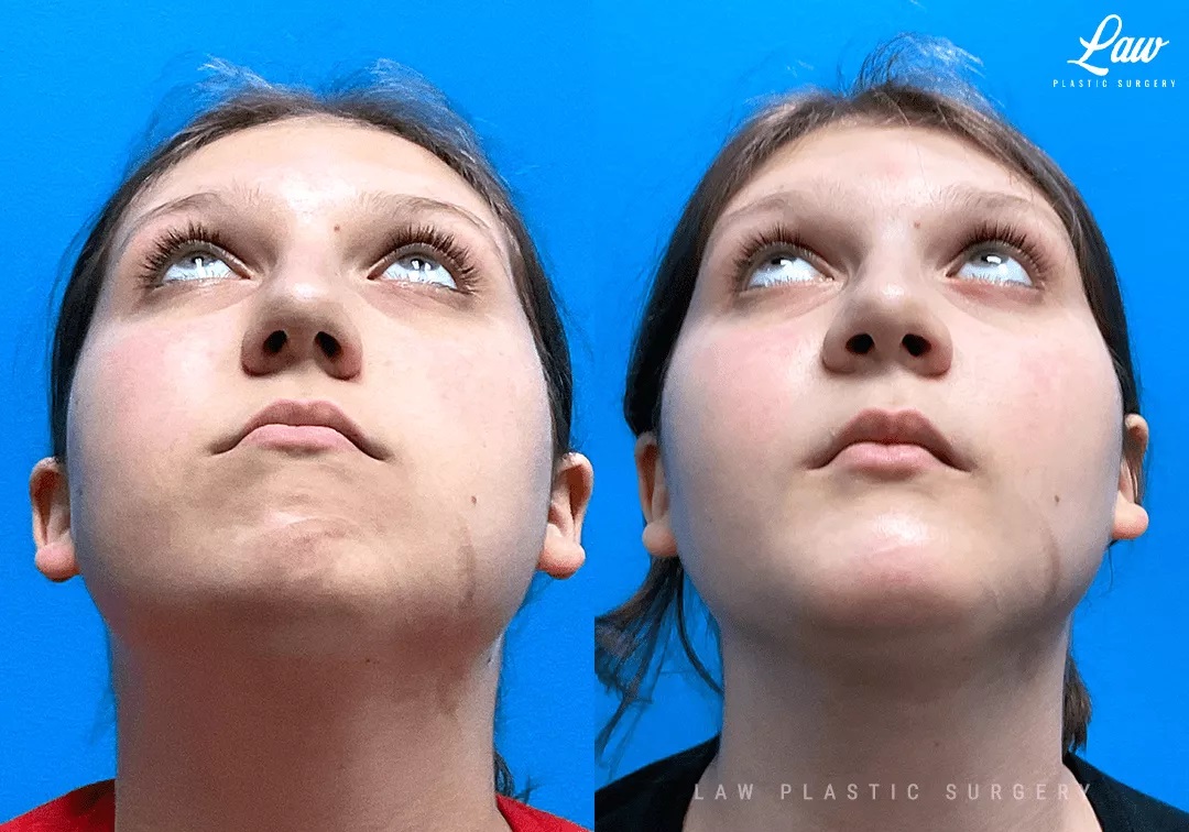 Chin Surgery (Genioplasty) Before and After Photo. Surgery performed in Dallas, TX at Law Plastic Surgery.