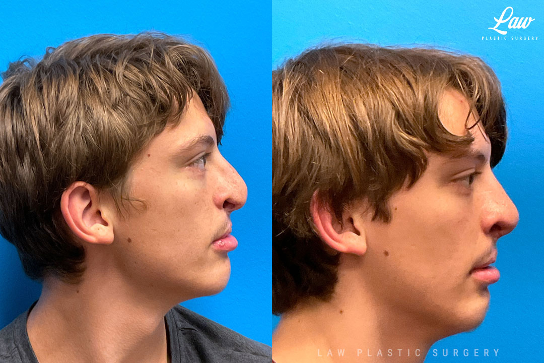 Cleft Rhinoplasty (Cleft Nose Surgery) Before & After Photo. Surgery performed in Dallas, TX at Law Plastic Surgery.