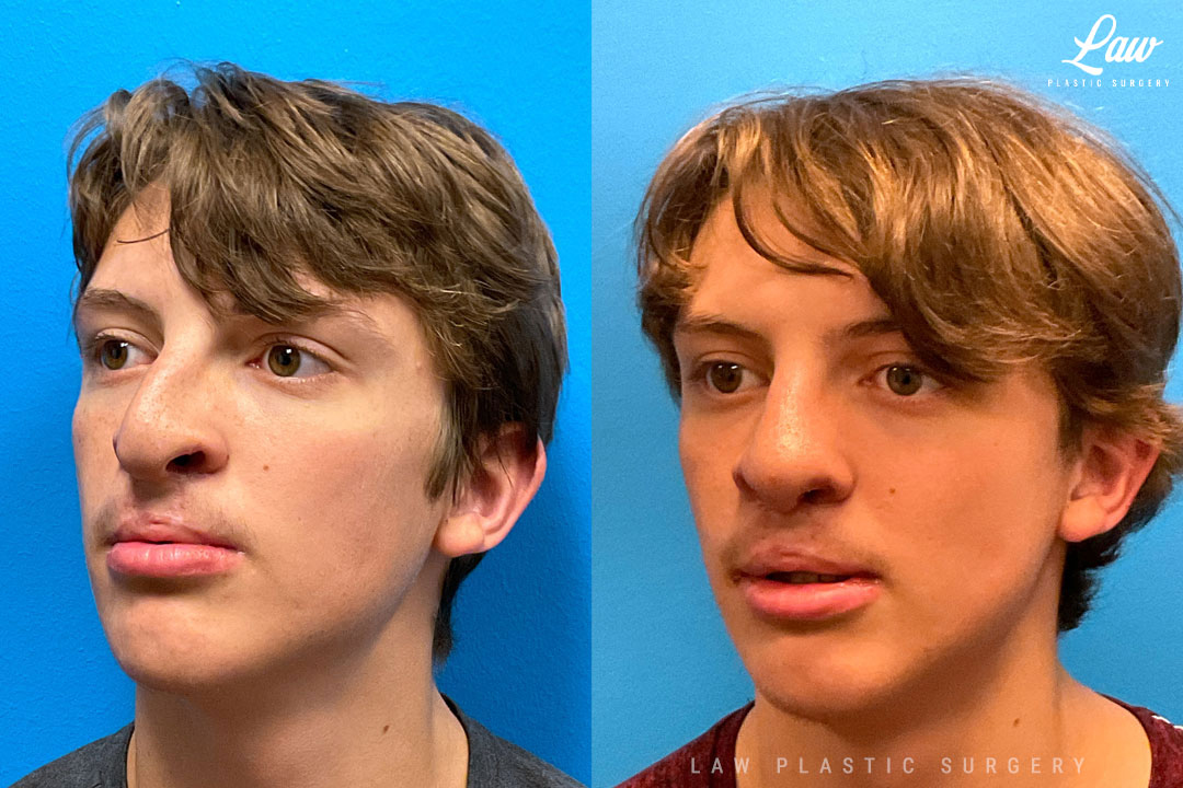 Cleft Rhinoplasty (Cleft Nose Surgery) Before & After Photo. Surgery performed in Dallas, TX at Law Plastic Surgery.