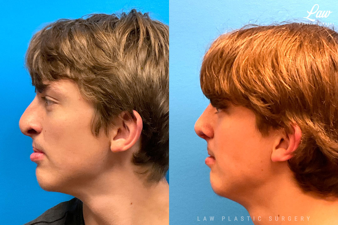 Cleft Rhinoplasty (Cleft Nose Surgery) Before & After Photo. Surgery performed in Dallas, TX at Law Plastic Surgery.