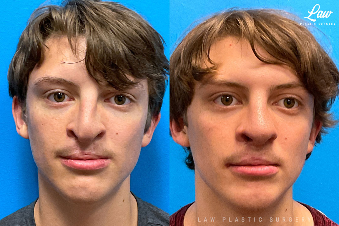 Cleft Rhinoplasty (Cleft Nose Surgery) Before & After Photo. Surgery performed in Dallas, TX at Law Plastic Surgery.