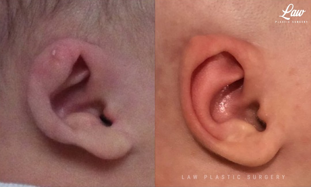 Ear Molding