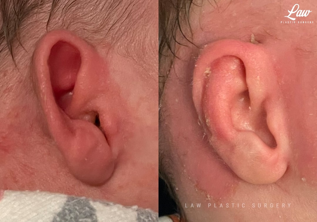 Ear Molding Before and After Photo. Surgery performed in Dallas, TX at Law Plastic Surgery.
