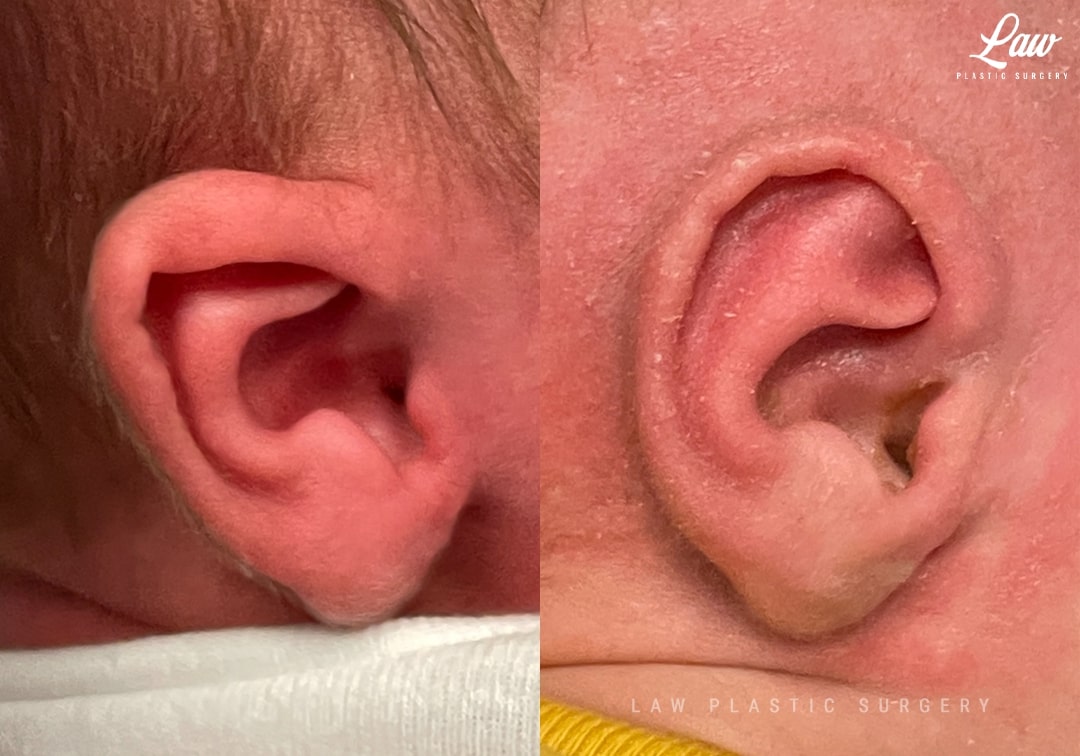 Ear Molding Before and After Photo. Surgery performed in Dallas, TX at Law Plastic Surgery.