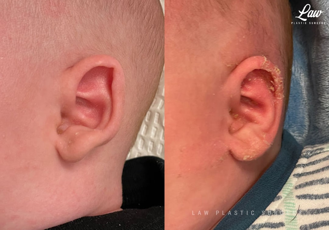 Ear Molding Before and After Photo. Surgery performed in Dallas, TX at Law Plastic Surgery.