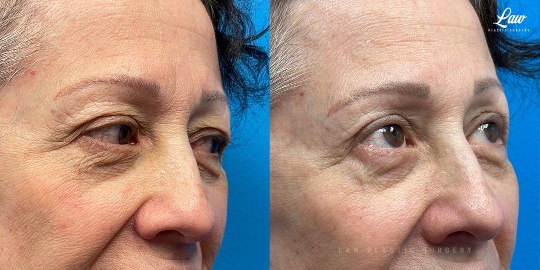 Eyelid Surgery (Blepharoplasty) Before & After Photo. Surgery performed in Dallas, TX at Law Plastic Surgery.