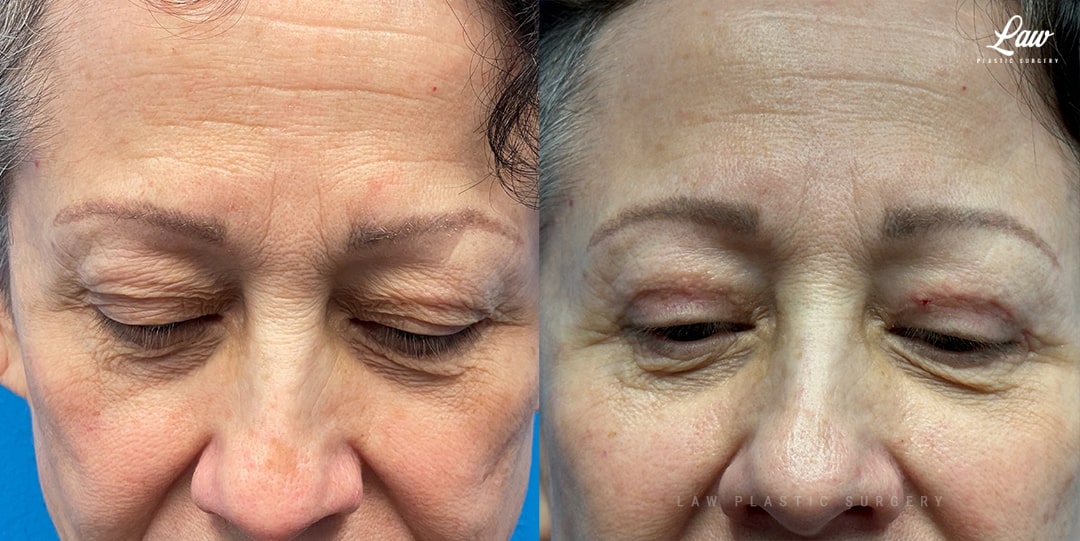Eyelid Surgery (Blepharoplasty) Before & After Photo. Surgery performed in Dallas, TX at Law Plastic Surgery.