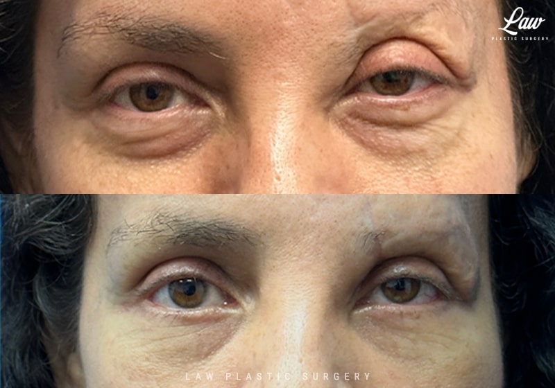 Eyelid Surgery (Blepharoplasty) Before & After Photo. Surgery performed in Dallas, TX at Law Plastic Surgery.