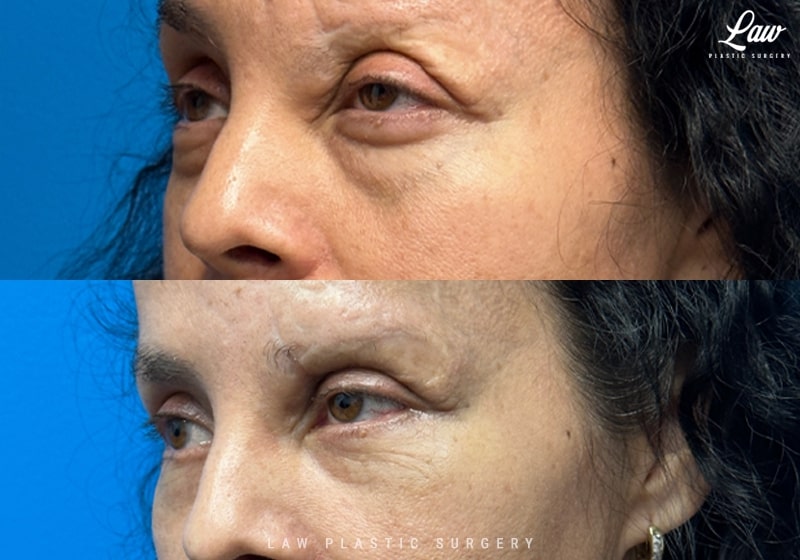 Eyelid Surgery (Blepharoplasty) Before & After Photo. Surgery performed in Dallas, TX at Law Plastic Surgery.