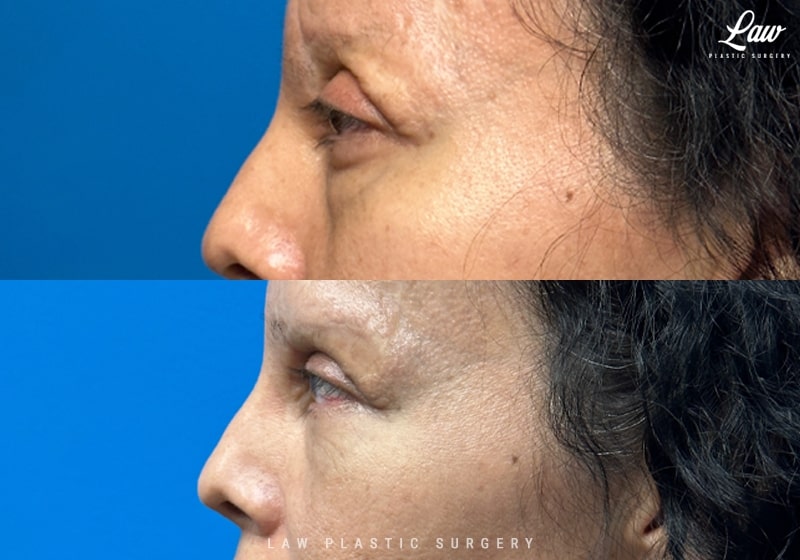 Eyelid Surgery (Blepharoplasty) Before & After Photo. Surgery performed in Dallas, TX at Law Plastic Surgery.