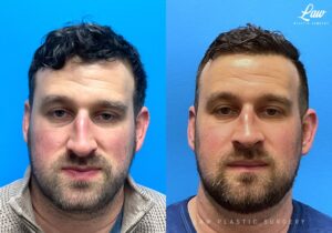 Jaw Surgery Before and After Photo. Surgery performed in Dallas, TX at Law Plastic Surgery.
