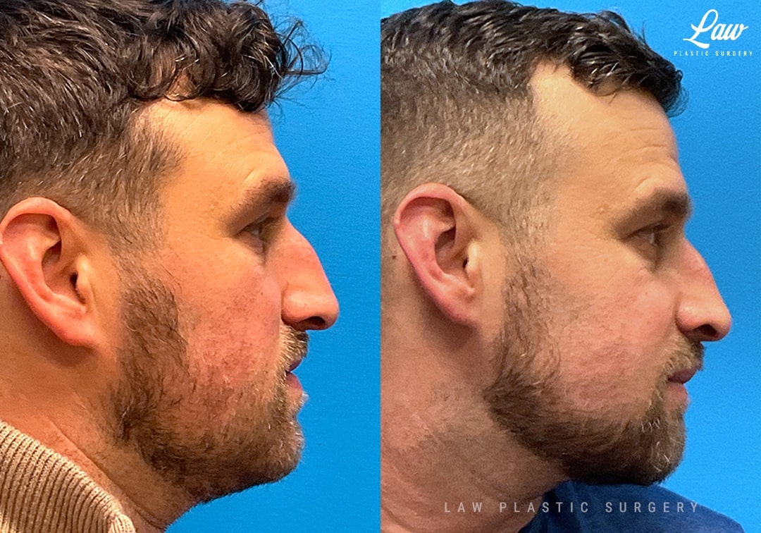 Jaw Surgery Before and After Photo. Surgery performed in Dallas, TX at Law Plastic Surgery.