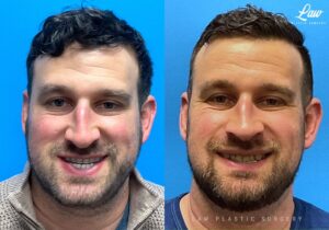 Jaw Surgery Before and After Photo. Surgery performed in Dallas, TX at Law Plastic Surgery.