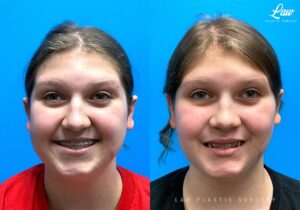 Jaw Surgery Before and After Photo. Surgery performed in Dallas, TX at Law Plastic Surgery.