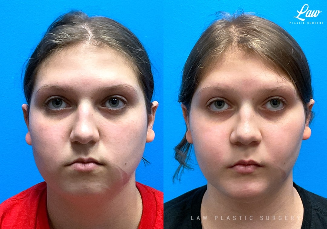 Jaw Surgery Before and After Photo. Surgery performed in Dallas, TX at Law Plastic Surgery.