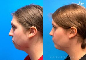 Jaw Surgery Before and After Photo. Surgery performed in Dallas, TX at Law Plastic Surgery.