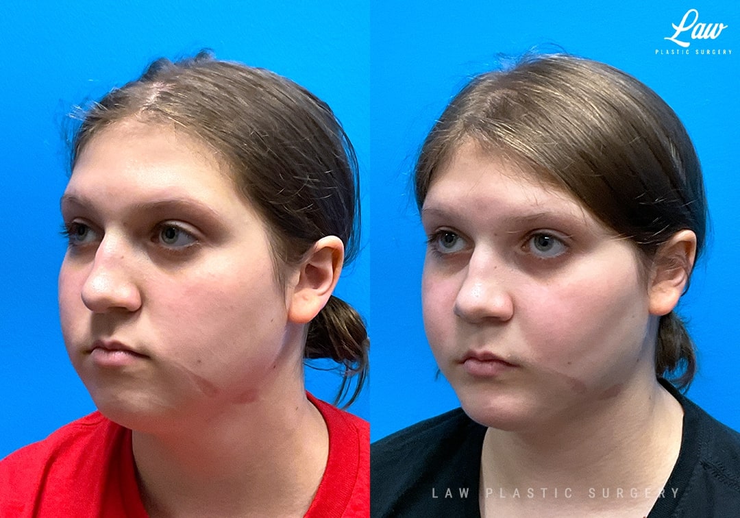 Jaw Surgery Before and After Photo. Surgery performed in Dallas, TX at Law Plastic Surgery.