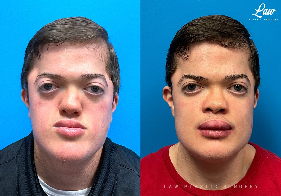 Jaw Surgery Before and After Photo. Surgery performed in Dallas, TX at Law Plastic Surgery.