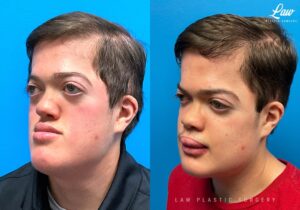 Jaw Surgery Before and After Photo. Surgery performed in Dallas, TX at Law Plastic Surgery.