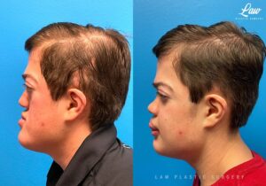 Jaw Surgery Before and After Photo. Surgery performed in Dallas, TX at Law Plastic Surgery.