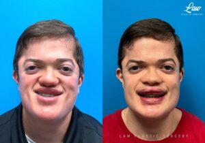 Jaw Surgery Before and After Photo. Surgery performed in Dallas, TX at Law Plastic Surgery.