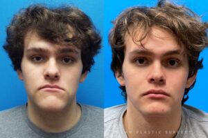 Jaw Surgery Before and After Photo. Surgery performed in Dallas, TX at Law Plastic Surgery.