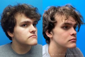 Jaw Surgery Before and After Photo. Surgery performed in Dallas, TX at Law Plastic Surgery.