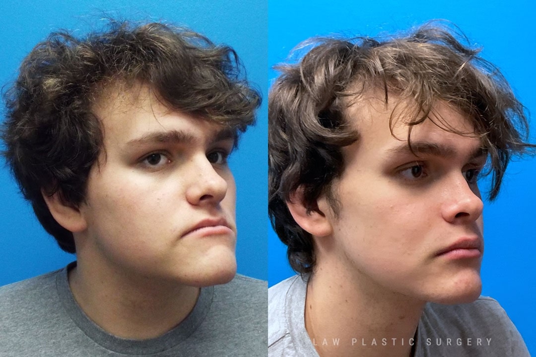 Jaw Surgery Before and After Photo. Surgery performed in Dallas, TX at Law Plastic Surgery.