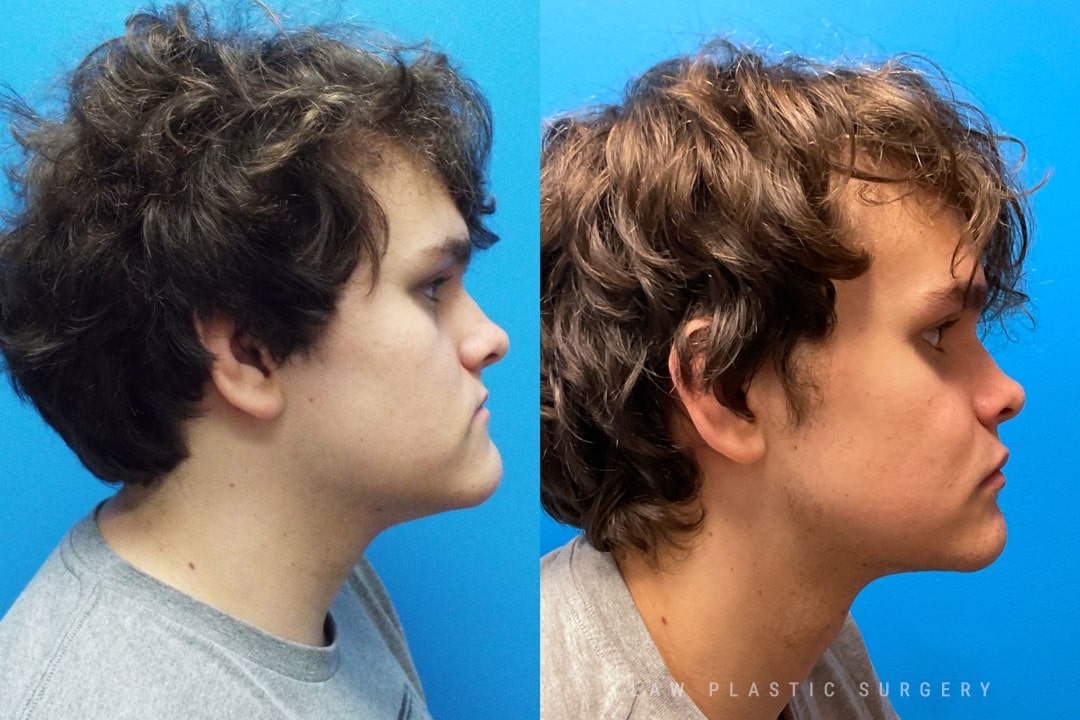 Jaw Surgery Before and After Photo. Surgery performed in Dallas, TX at Law Plastic Surgery.